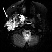 図3、右頚部リンパ管腫（MRI）嚢胞内のリンパ液は白く見えます。